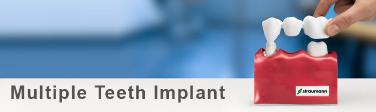 Multiple Teeth Implant