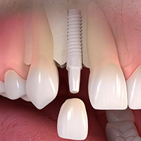 Single dental implants