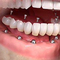 Full arch dental implants