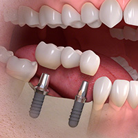 Multiple dental implants