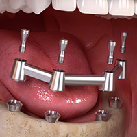 Full Arch Overdentures