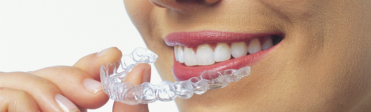 Invisalign