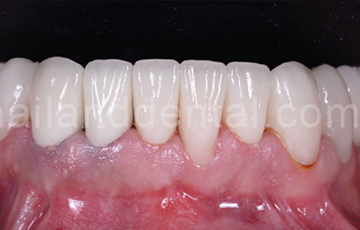 Dental Crowns