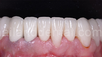 Case Crowns