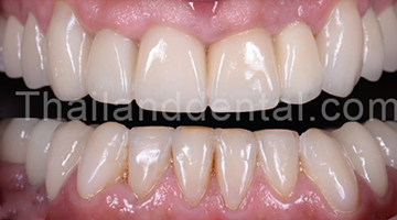 Case Crowns