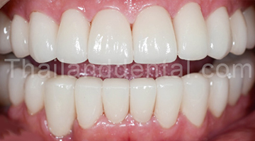 Case Crowns