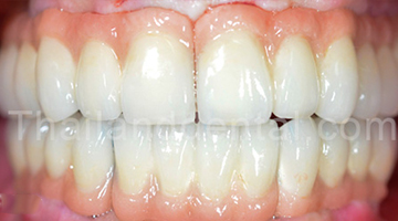 Case Implant All-On-4