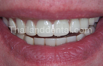 Dental Implants