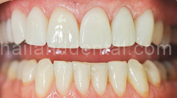 Case Veneers