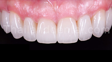 Case Veneers