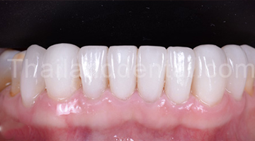 Case Veneers