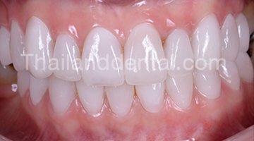 Case Veneers