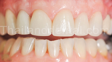 Case Veneers