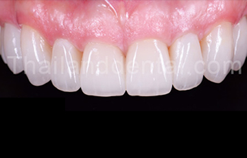 Case Tooth Whitening