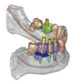 Dental Implant Equipment